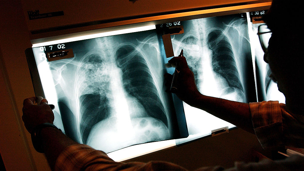 2 active tuberculosis cases traced to San Francisco strip club — KTVU FOX 2 Bay Area, Mill Valley Health news